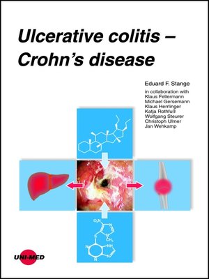 cover image of Ulcerative colitis--Crohn's disease